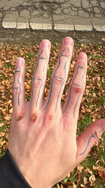 Wounded knuckles after training